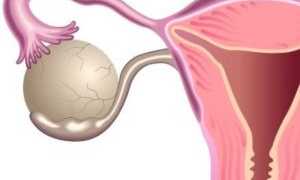 Появилась киста после родов: методы диагностики, лечение и профилактика