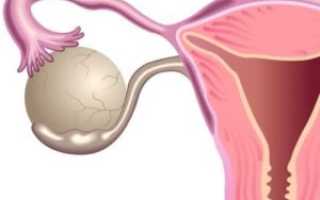 Появилась киста после родов: методы диагностики, лечение и профилактика