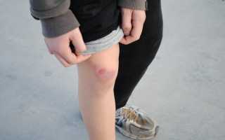 Как лечить ушиб колена и быстро восстановиться