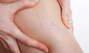 Опасный варикоз на ногах после родов: причины появления и эффективные методы борьбы с ним