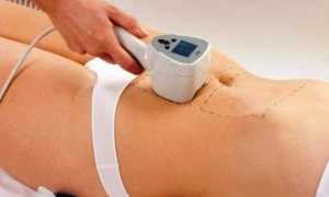 Насколько эффективен лазер от растяжек после родов?