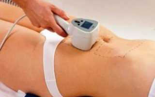 Насколько эффективен лазер от растяжек после родов?