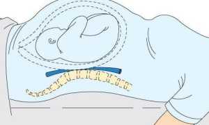 Как проявляется синдром нижней полой вены
