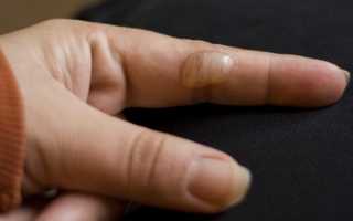 Правила оказания первой помощи при ожогах