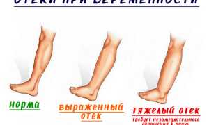 Опасны ли отеки при беременности на поздних сроках, способы борьбы с ними