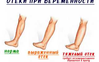 Опасны ли отеки при беременности на поздних сроках, способы борьбы с ними