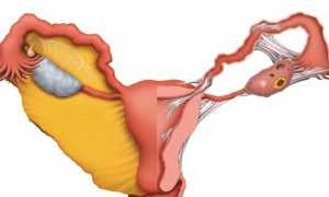 Спайки после КС: все, что нужно знать женщине
