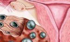 Если проблема в эстрогене, поможет Прогинова при планировании беременности