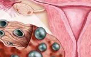 Если проблема в эстрогене, поможет Прогинова при планировании беременности