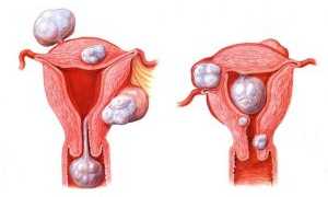Почему появляется миома матки после родов и что делать дальше?