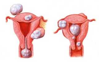Почему появляется миома матки после родов и что делать дальше?
