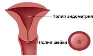 Угроза для жизни матери и ребенка вне зависимости от срока беременности — это акушерские кровотечения