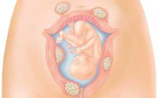 Как проявляется миома при беременности на ранних сроках