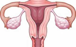 Воспаление матки как осложнение после родов