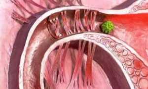 Трубно-перитонеальное бесплодие: способы диагностики и лечения