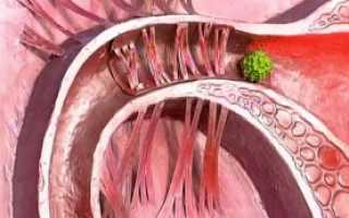 Трубно-перитонеальное бесплодие: способы диагностики и лечения