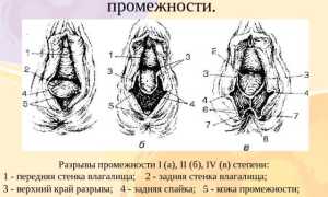Как проходят роды через кесарево сечение