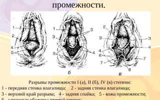 Как проходят роды через кесарево сечение