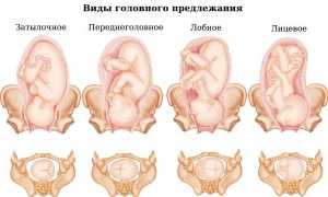 Крайне неудачное и опасное лицевое предлежание плода: особенности родоразрешения и последствия