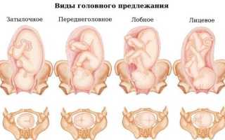Крайне неудачное и опасное лицевое предлежание плода: особенности родоразрешения и последствия