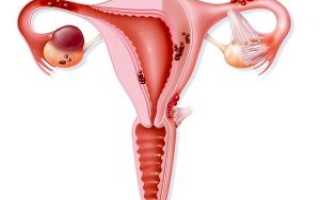 Коварное заболевание для молодой мамы — эндометриоз после родов