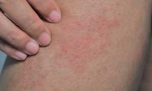 Так ли безопасен зуд при беременности на поздних сроках