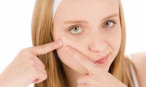 Некрасивые прыщи после родов: причины появления и методы избавления