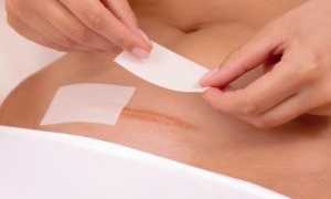 Как обрабатывать шов после кесаревого сечения