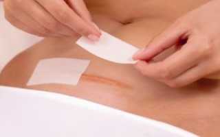 Как обрабатывать шов после кесаревого сечения