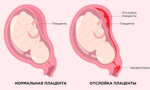 Чем грозит отслойка плаценты на поздних сроках беременности