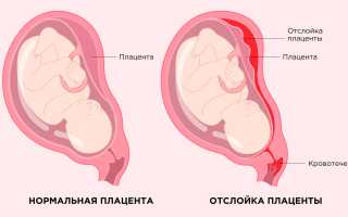 Чем грозит отслойка плаценты на поздних сроках беременности