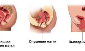 Диагноз Опущение стенки матки после родов: симптомы, диагностика, лечение и способы помочь себе
