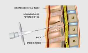 Особенности введения эпидуральной анестезии при родах