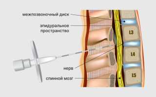 Особенности введения эпидуральной анестезии при родах