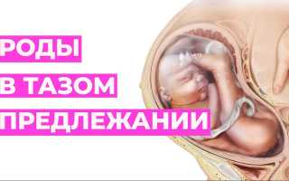 Как проходят роды при тазовом предлежании плода