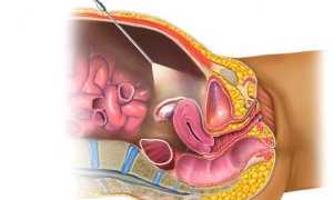 Что ожидать, если предстоит лапароскопия на раннем сроке ожидания малыша