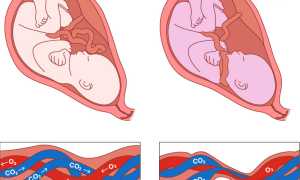 Опасность обвития пуповины плода и варианты родоразрешения