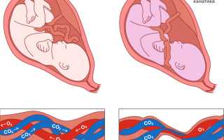 Опасность обвития пуповины плода и варианты родоразрешения