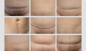 Какими могут быть роды после операций