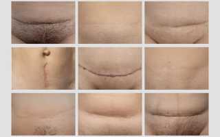 Какими могут быть роды после операций