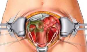 Альтернатива хирургическому вмешательству при миоме матки — эмболизация маточных артерий
