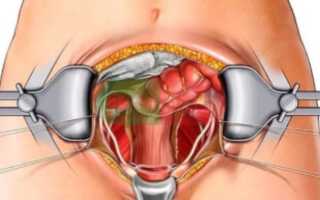 Альтернатива хирургическому вмешательству при миоме матки — эмболизация маточных артерий