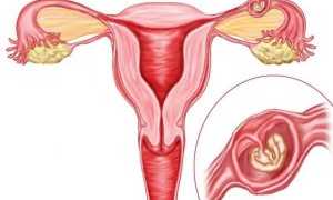 Почему развивается внематочная беременность