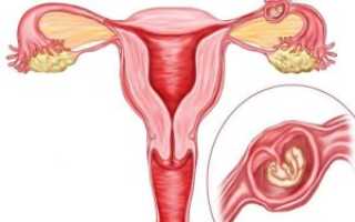 Почему развивается внематочная беременность