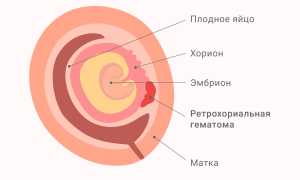 Страшна ли гематома в матке при беременности?