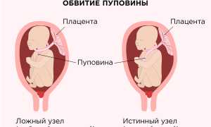 Какая может быть аномалия плаценты, пуповины, их угроза для матери и ребенка