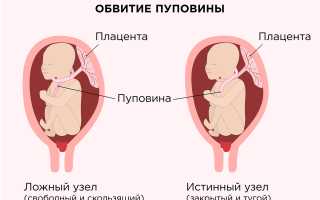 Какая может быть аномалия плаценты, пуповины, их угроза для матери и ребенка