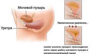 Неприятная, но устранимая проблема — недержание мочи после родов