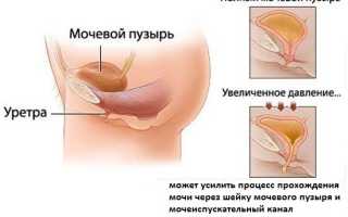 Неприятная, но устранимая проблема — недержание мочи после родов