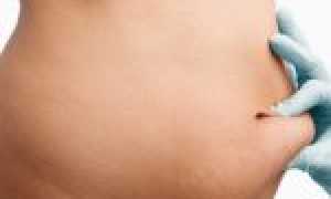 Появилась дряблая кожа после родов: методы борьбы для возвращения красоты и свежести